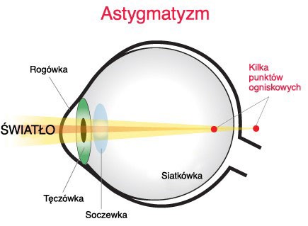 echo fade Mutual Astygmatyzm | Optik Center Ekspres - okulary, soczewki, optyk Szczecin,  Świnoujście